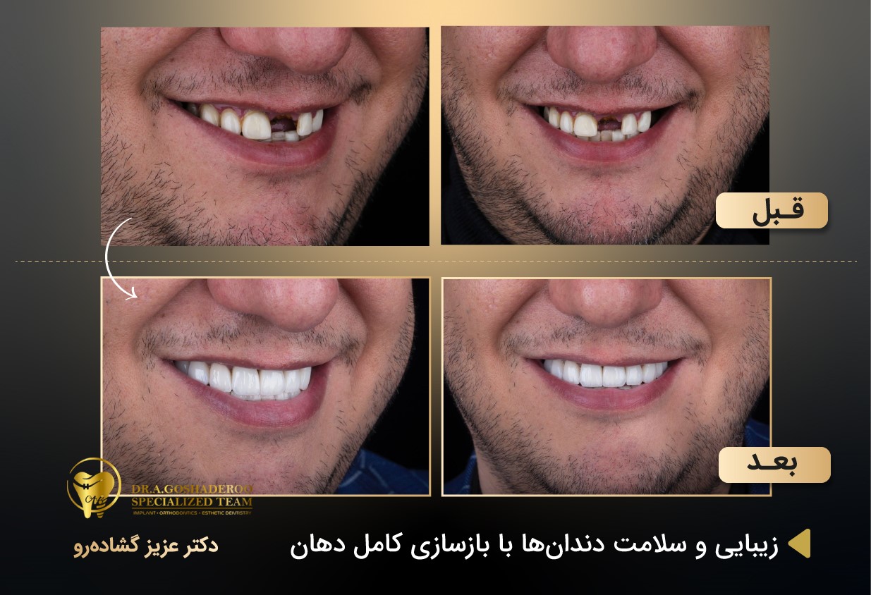 زیبایی و سلامت دندان ها با بازسازی کامل دهان